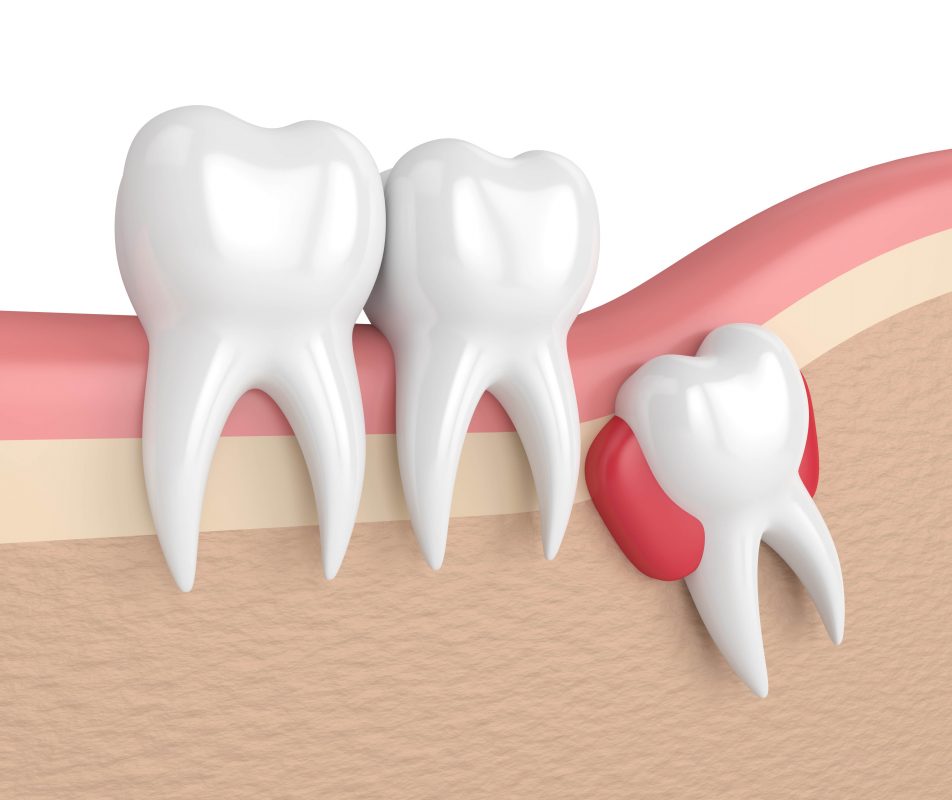 Wisdom Tooth Cysts Nova DiŞ 3235