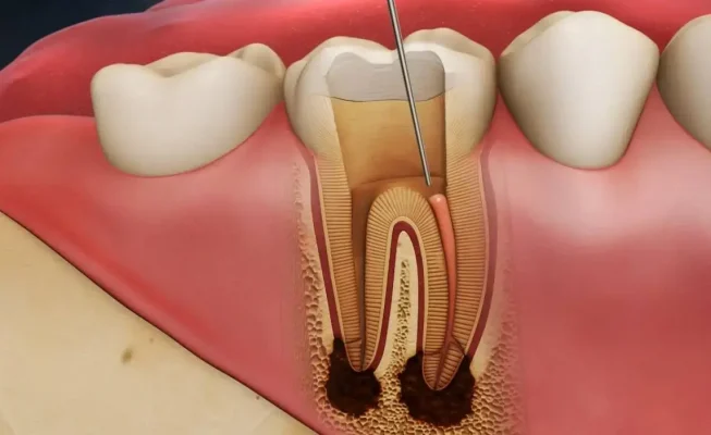 endodonti nedir sorusunun cevabı bir diş hekimliği alanı olmasıdır