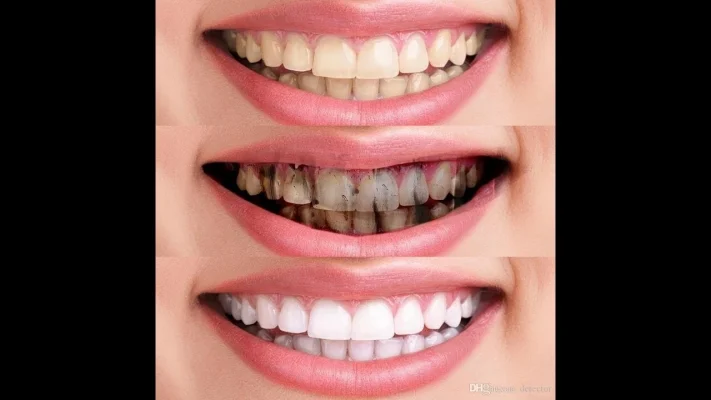 Dişlerdeki Siyah Lekeler