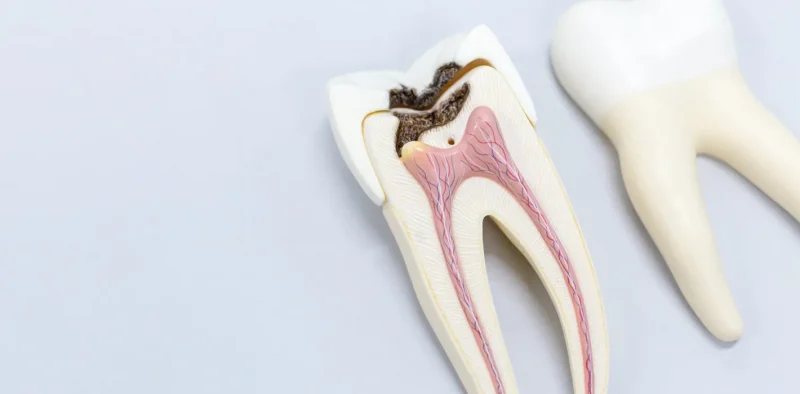Kökü Kalan Kırık Diş Tedavisi